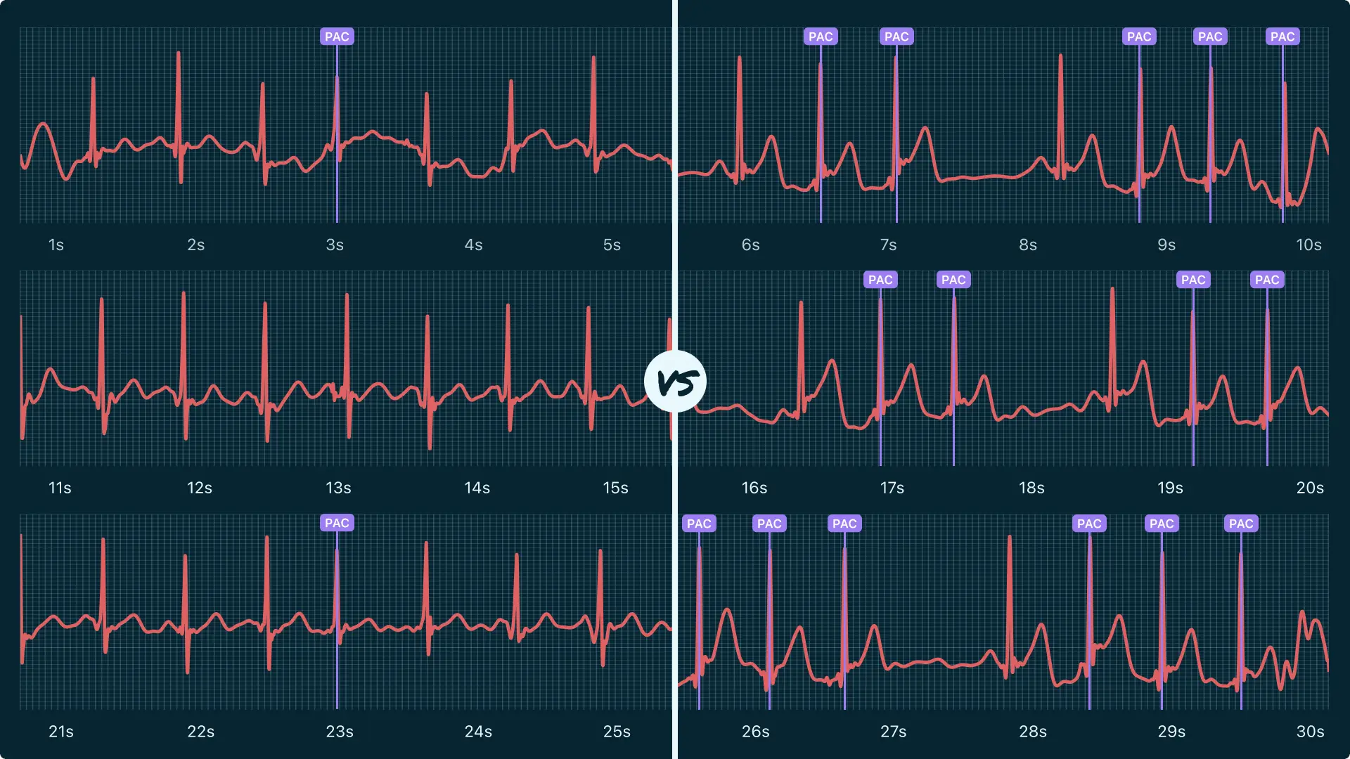 Premature Atrial Contraction (Multiple) Vs. Supraventricular